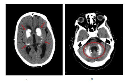 Seizures and Bilateral Basal Ganglia Calcifications Following Thyroidectomy