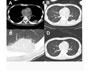 Delayed Pneumonia Caused By Nonionic Soluble Contrast Media