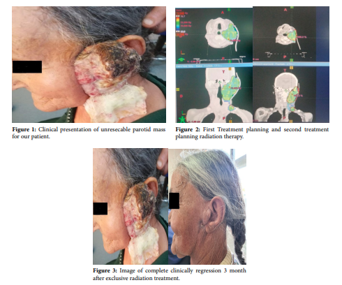 Complete Remission of Squamous Cell Carcinoma of Parotid Gland with Exclusive Radiotherapy