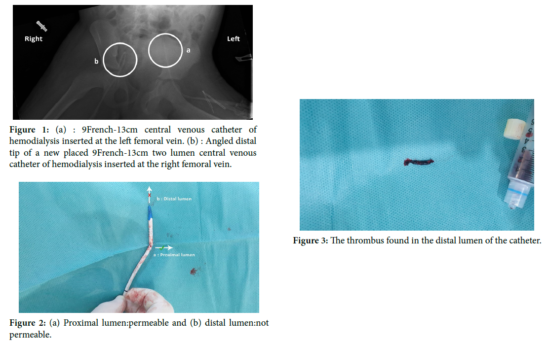 When Distal lumen of a Central Venous Catheter of Hemodialysis does not return blood : A case report