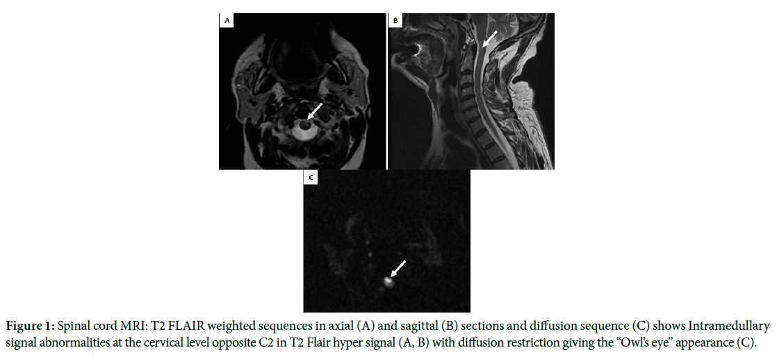 Acute Spinal Cord Infarction: A Case Report