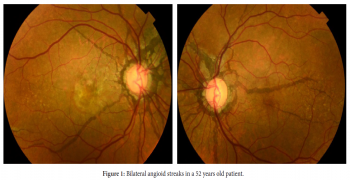 Manifest Bilateral Angioid Streaks!