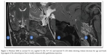 Hypophysive Hemochromatosis: A Rare Cause of Hypothyroidism