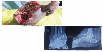 Amputation of Right Diabetic Toe with Wet Gangrene: A Rare Clinical Image
