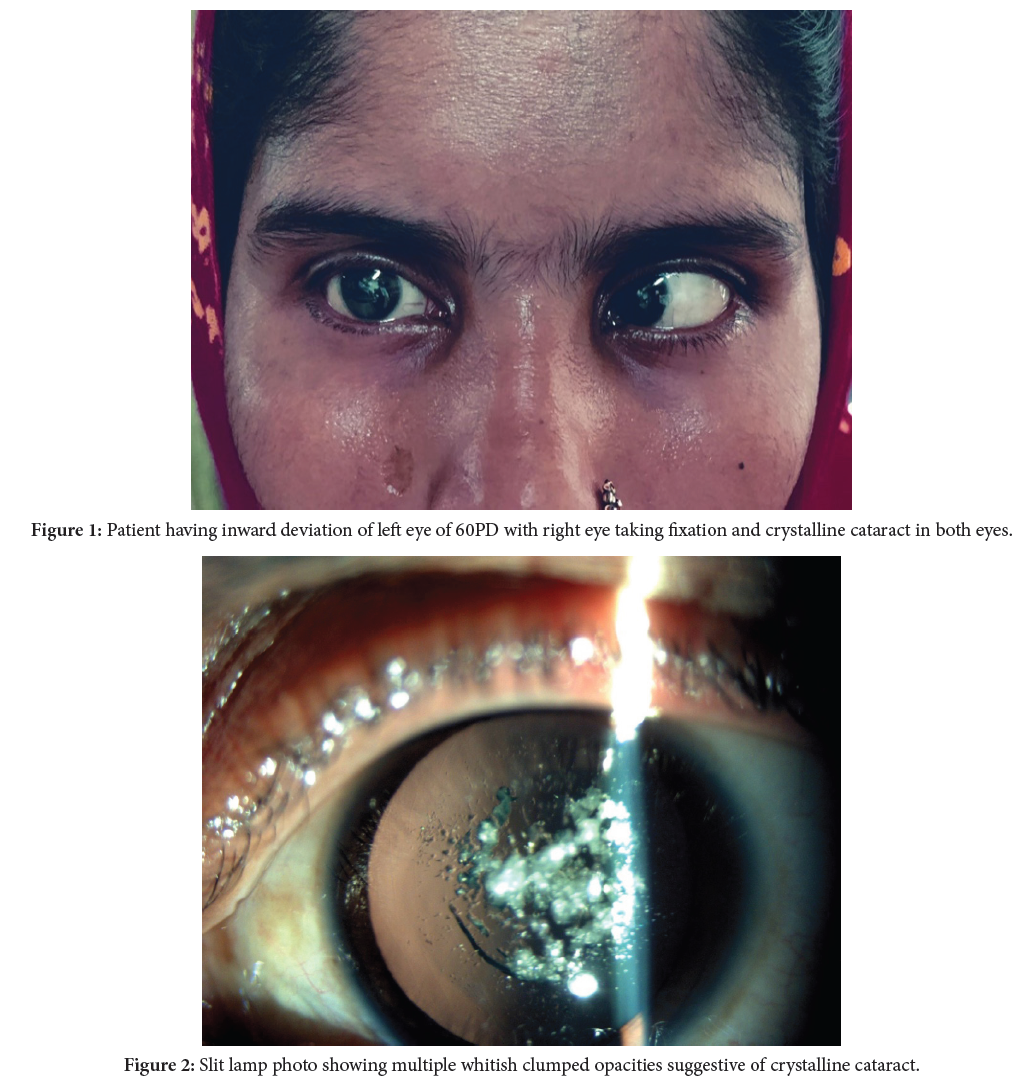 Infantile Esotropia With Crystalline Cataract