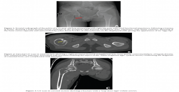 Essential Bone Cyst: Fallen Fragment Sign and Trap Door Sign