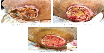 Large Healing Bed Sore in a Diabetic patient with Myeloma causing Compressive Paraparesis