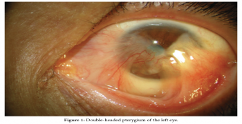 Double-Head Pterygium Treated with Amniotic Membrane Graft
