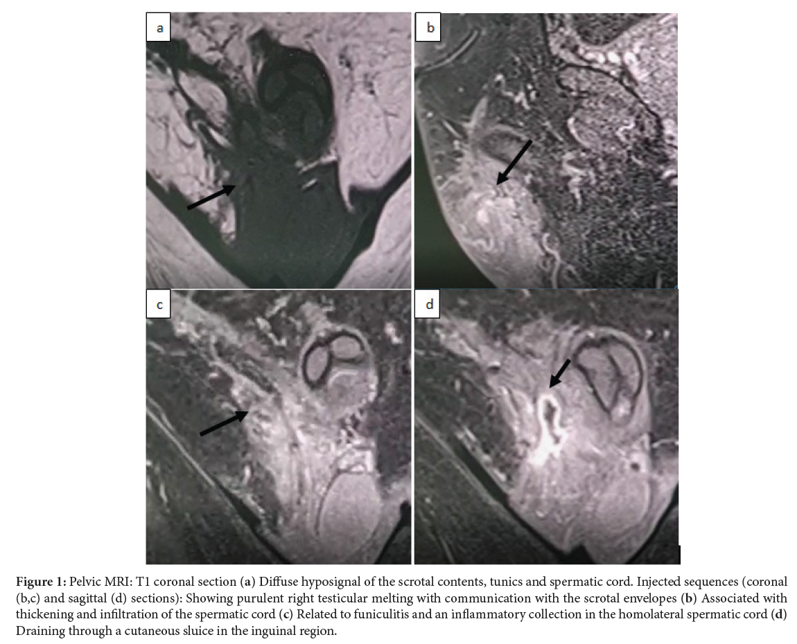 Recurrent Orchiepidydimitis Complicated by Purulent Melting of the Testicle: Case Report
