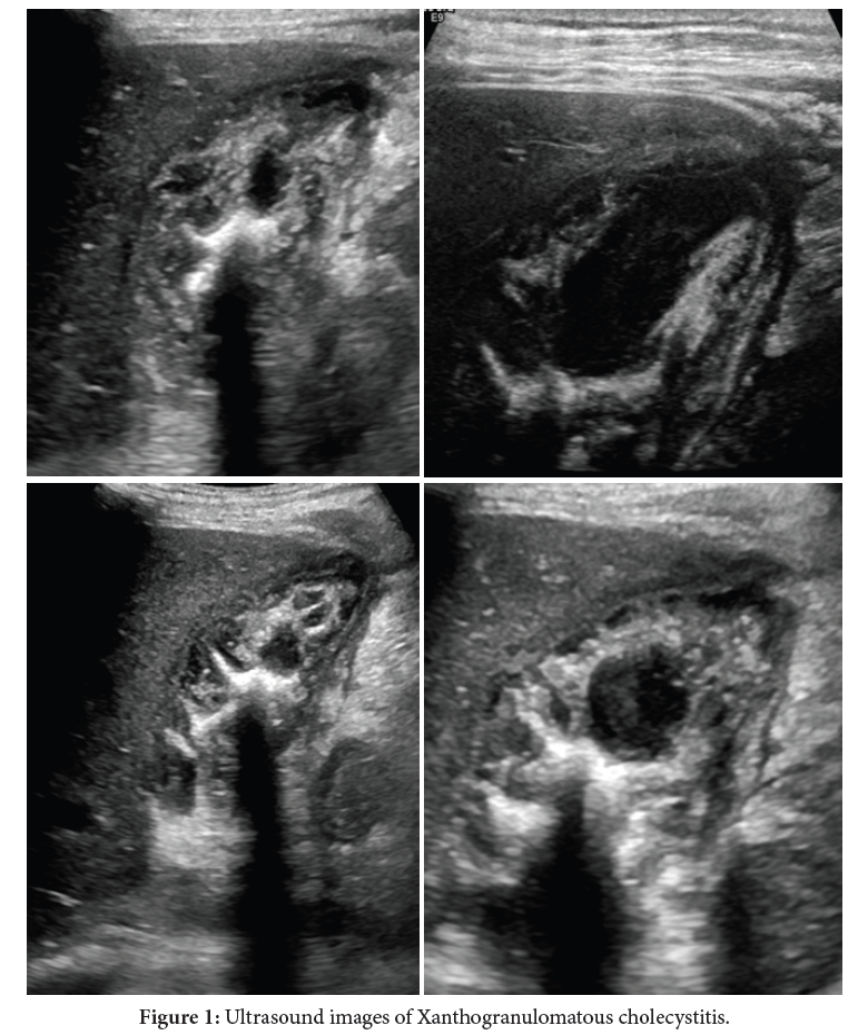 Xanthogranulomatous Cholecystitis: Role of High Resolution Ultrasound (HRUS) in the Diagnosis