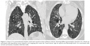 Hypersensitivity Pneumonitis: The Head Cheese Sign