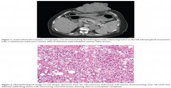 Cutaneous metastasis revealing adrenal cortical carcinoma