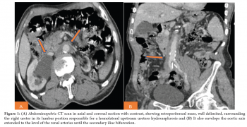 Retroperitoneal Fibrosis