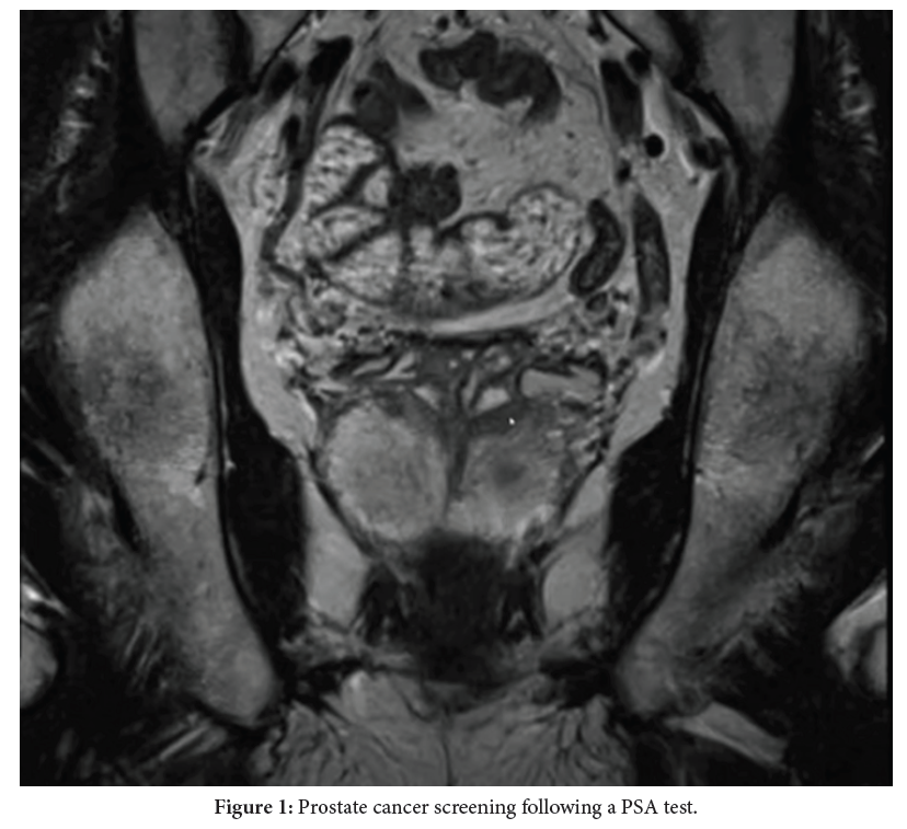PSA Test is the Use of MRI: Cost-Effective Method for Prostate Cancer Screening