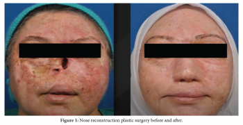 Nose Reconstruction Plastic Surgery: Improving Function and Appearance of the Nose