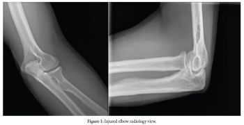 Radiology's Role in Diagnosing and Treating Dislocated Elbow Injuries