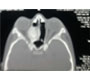 Ossifying Fibroma In Left Ethmoidal Sinus In 11years Old Iranian Boy