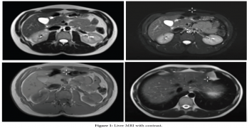 Liver MRI with Contrast: A Comprehensive Guide to the Procedure and What to Expect