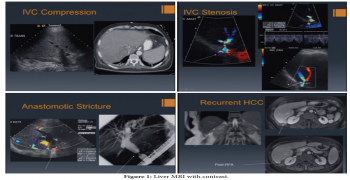 Imaging of Liver Transplants Procedure by MRI