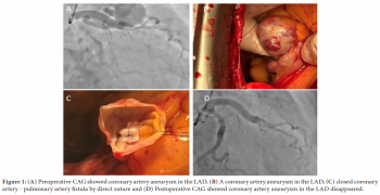 Coronary Artery Rupture Due to Giant Coronary Artery Aneurysm