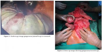 Jejuno-Gastric Intussusception with Gangrene of Jejunal Segment-A Case Report of Rare Life-Threatening Complication of Gastro- Jejunostomy