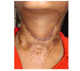 A Case Of Classical Casal's Necklace In An 8 Year Old Boy