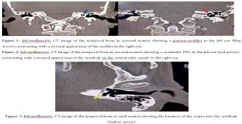 Rotatory Vertigo Revealing Post-Traumatic Combined Pneumolabyrinth: A Case Report