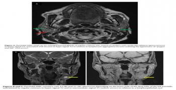 Multi-cystic parotids