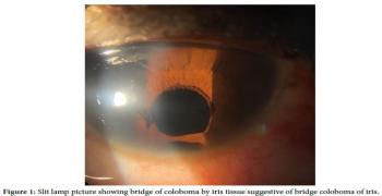 UNILATERAL BRIDGE COLOBOMA OF IRIS ÃƒÂ¢Ã¢Â‚Â¬Ã¢Â€Âœ RARE VARIETY