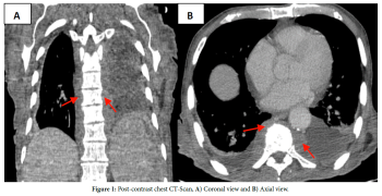 Thoracic Paravertebral Extramedullary Hematopoiesis