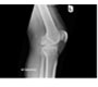 Synovial Chondromatosis