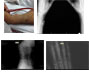 Vascular Calcificación in Dialysis-Treated End-Stage Renal Disease