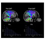 Increased Corona Radiata And Cerebellar Tracts Following Quadrato Motor Training: A Pilot Diffusion Tensor Imaging Study