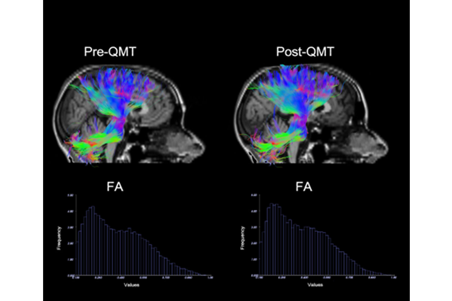 Increased Corona Radiata And Cerebellar Tracts Following Quadrato Motor Training: A Pilot Diffusion Tensor Imaging Study