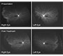 Ultra-widefield Fluorescein Angiography Of Familial Exudative Vitreoretinopathy