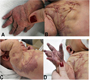 A Newborn with Klippel-Trénaunay Syndrome