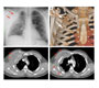 Extensive Extra-Pulmonary Chest Wall Hydatidosis